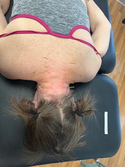 Dry Needling in Reno, NV