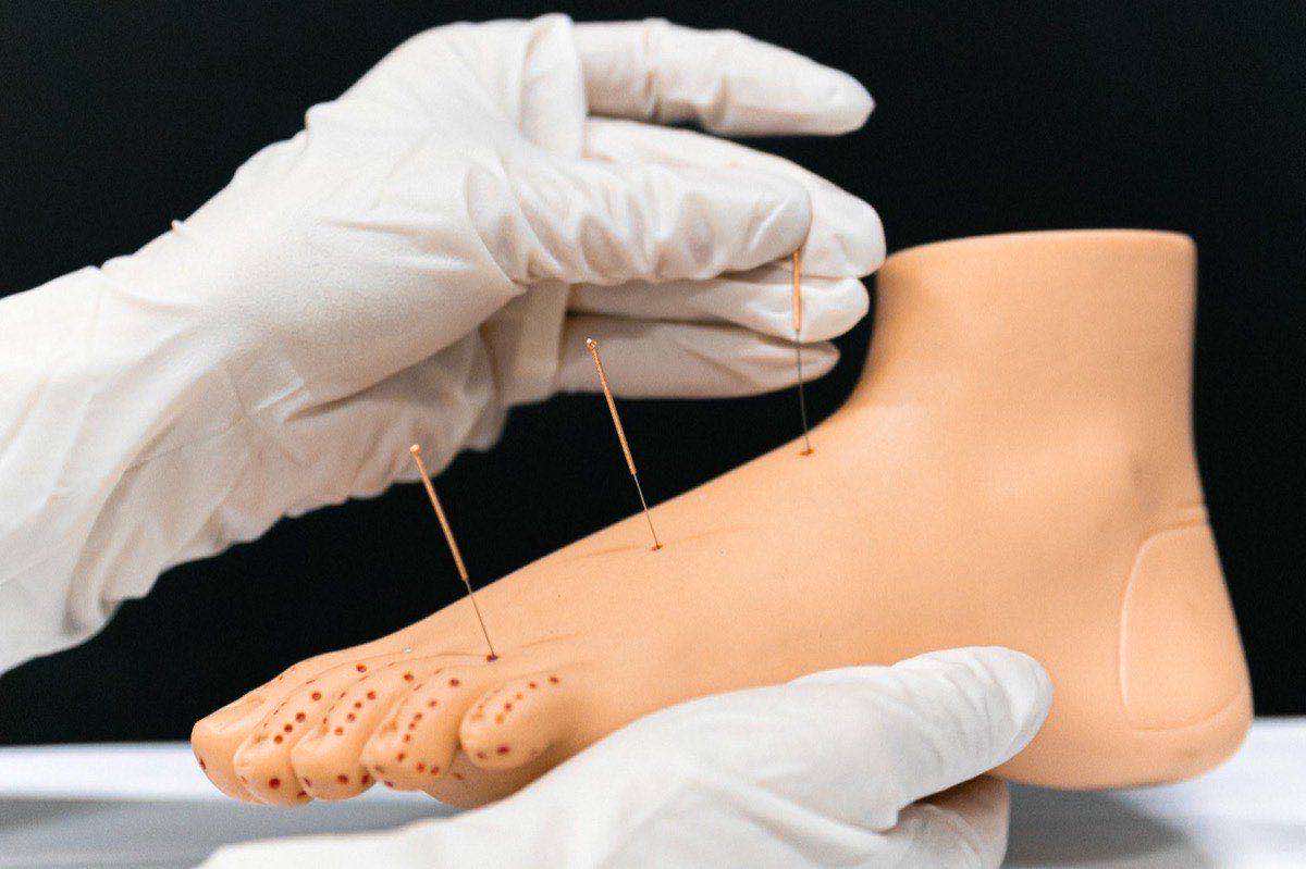 Dry Needling for Plantar Fasciitis: Heel Pain Relief in Reno