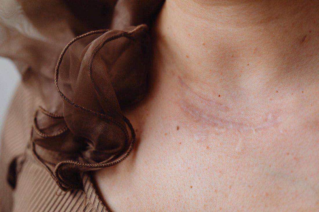 Scar Tissue and Adhesion Release After Surgery: Myofascial Work in Reno