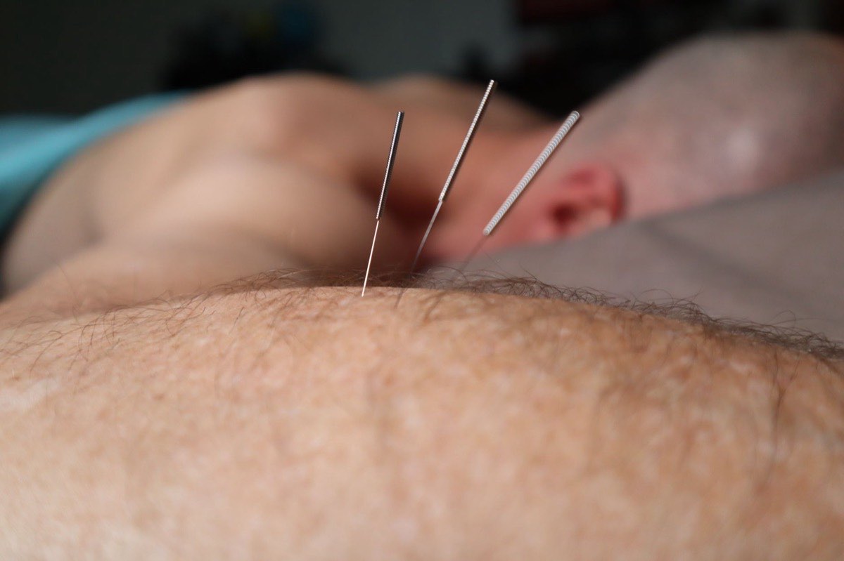 Dry Needling Is NOT Acupuncture: What It Actually Is and How It Works